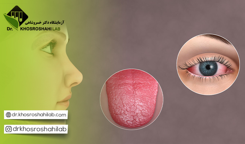 عوارض بیماری شوگرن